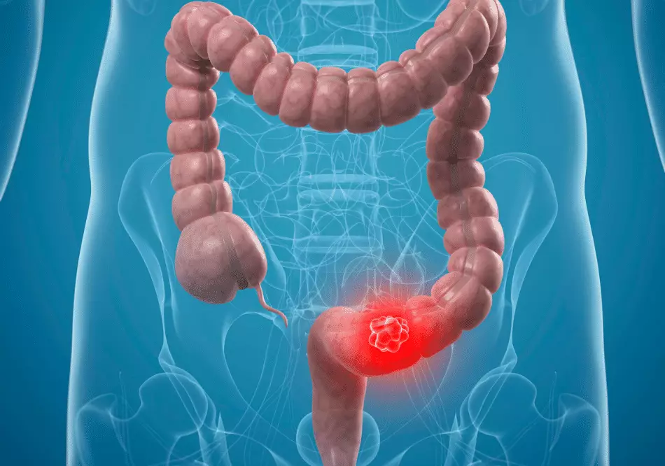 Colonal Rectal Cancer_ treatment in Ayurveda | Arogyavedh Ayurveda | Dr. Banashree Patil Baner Balewadi