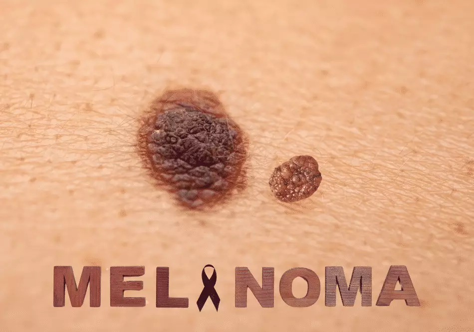 Melanoma Cancer_ treatment in Ayurveda | Arogyavedh Ayurveda | Dr. Banashree Patil Baner Balewadi