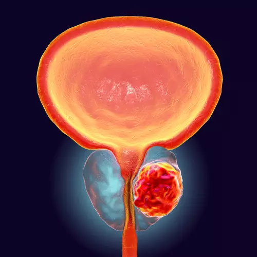 Prostate Cancer treatment in Ayurveda | Arogyavedh Ayurveda | Dr. Banashree Patil Baner Balewadi