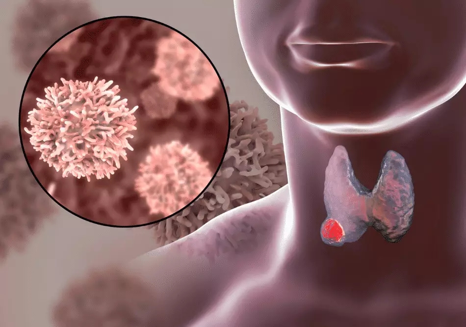 Thyroid Cancer_ treatment in Ayurveda | Arogyavedh Ayurveda | Dr. Banashree Patil Baner Balewadi