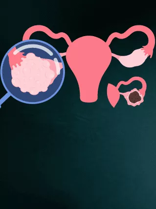 PCODPCOS treatment