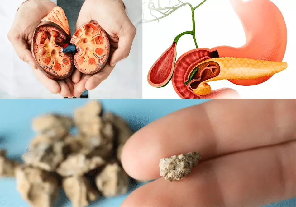 kidney stone gall bladder stone urinary bladder treatment in ayurveda