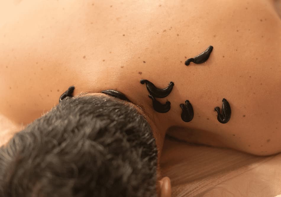 leech used in ayurvedic treatment