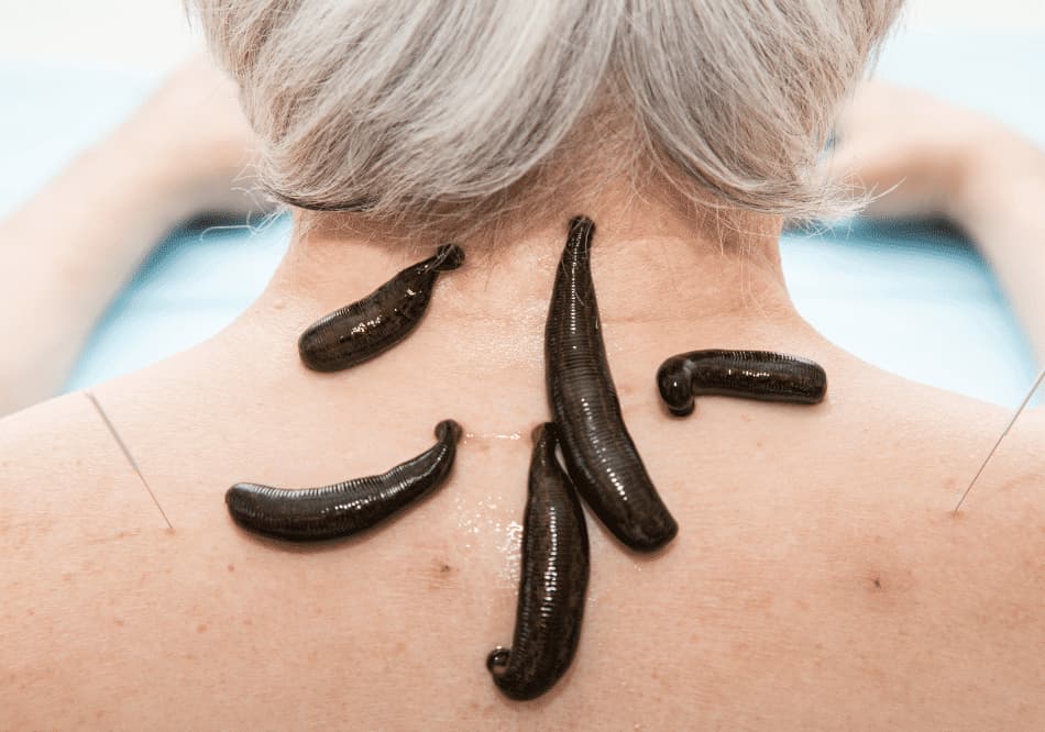 leeches for treatment in ayurveda