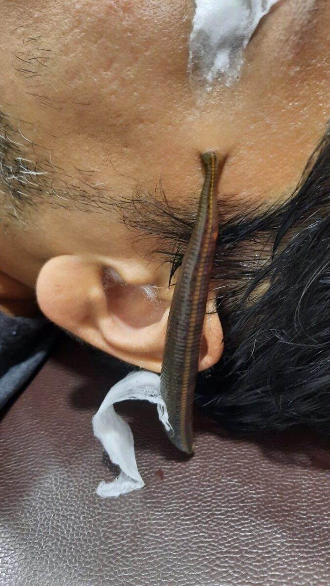Leech therapy in Ayurveda baner