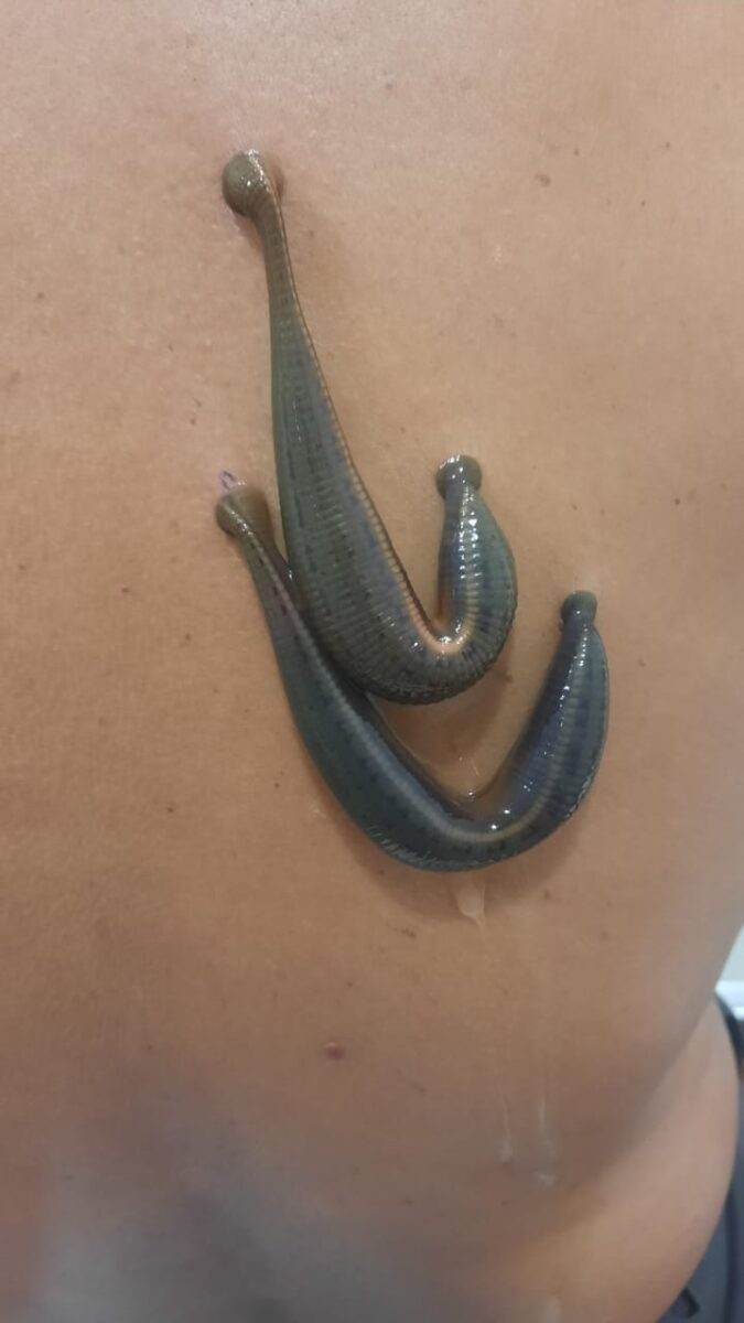 Leech therapy in Ayurveda baner balewadi